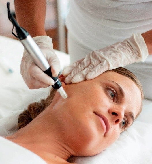 Microneedling