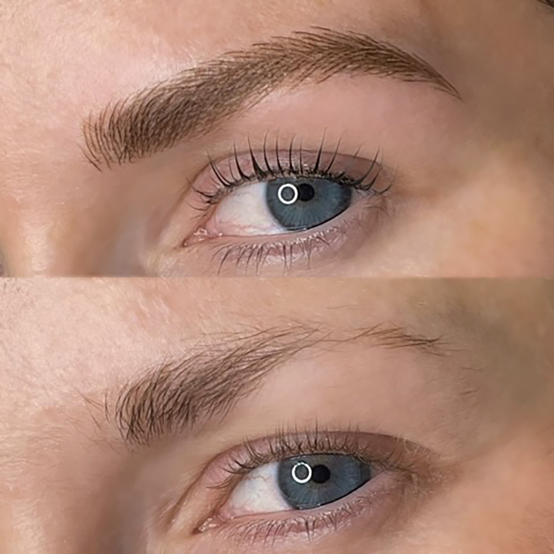 brow lift